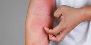 Read more about the article Treat eczema with the help of Ayurveda and receive impressive results