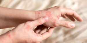 Read more about the article Say Goodbye to Eczema Problems with the Help of Effective Ayurvedic Treatment