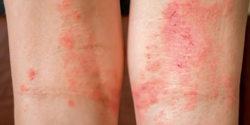 You are currently viewing Treat the Problem of Dermatitis with the Aid of an Expert Dermatologist