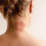 Why Managing Eczema is the First Step to Successful Skin Tightening