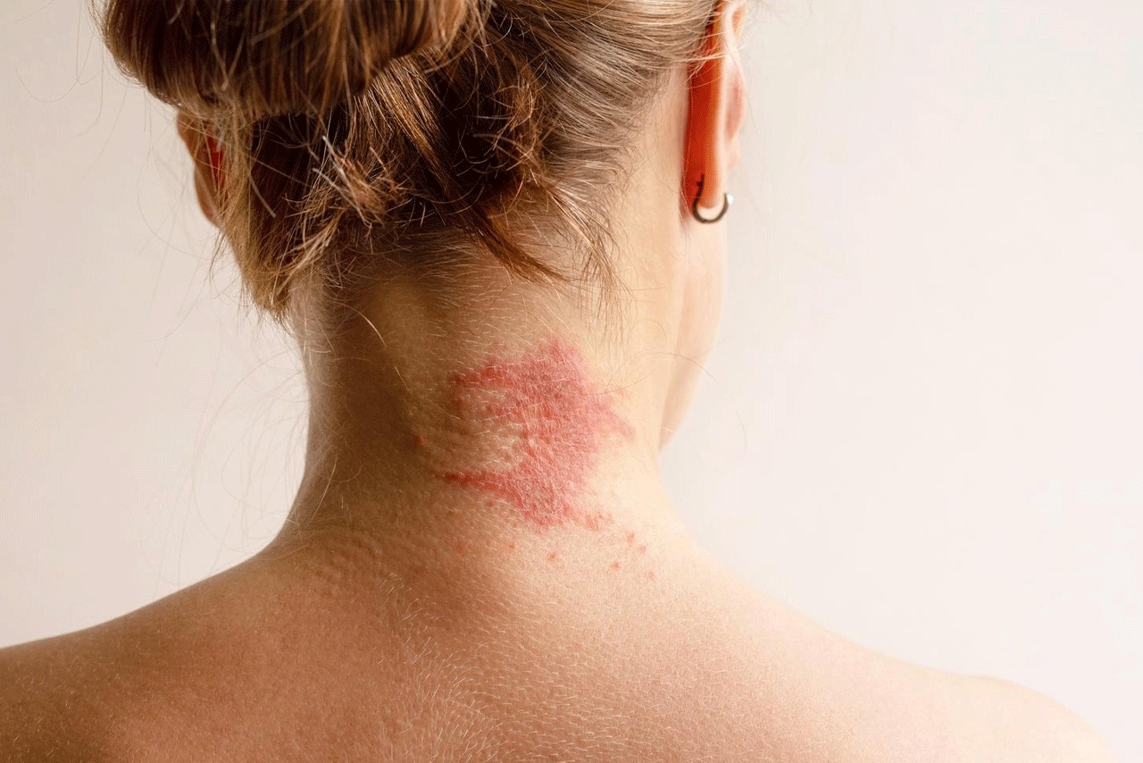 You are currently viewing Why Managing Eczema is the First Step to Successful Skin Tightening