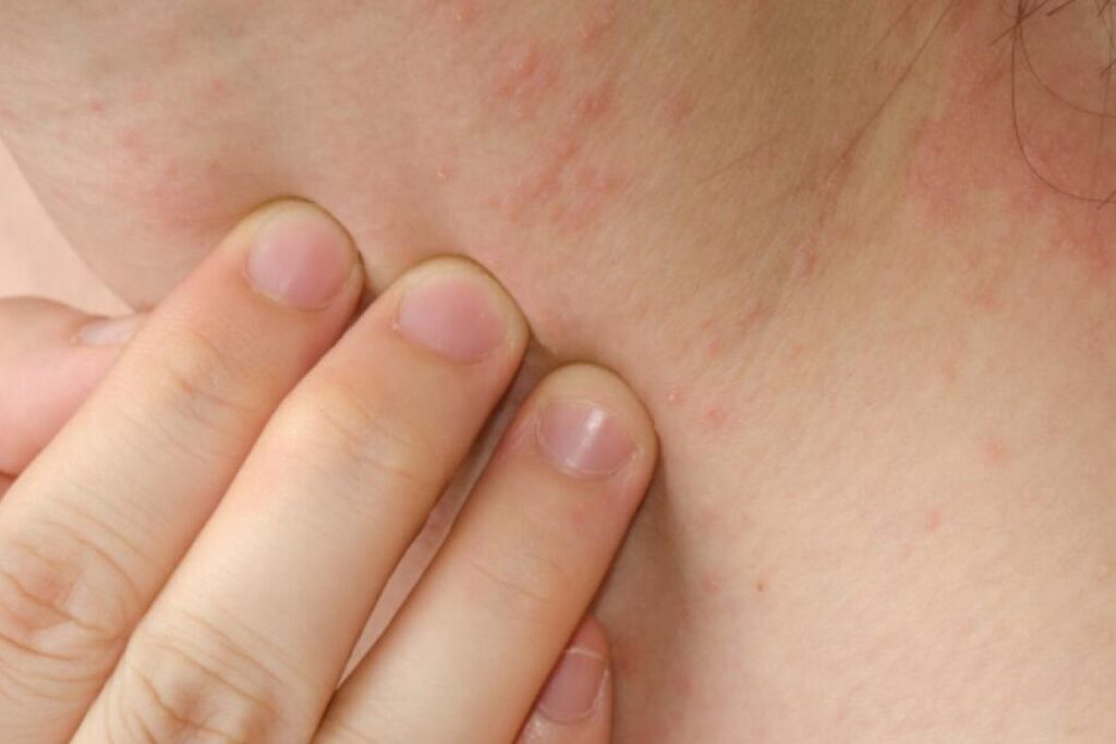 Reliable Help with Contact Dermatitis Treatment in Sharjah