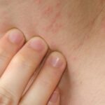 Reliable Help with Contact Dermatitis Treatment in Sharjah