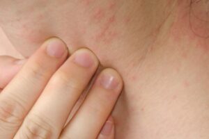 Read more about the article Reliable Help with Contact Dermatitis Treatment in Sharjah