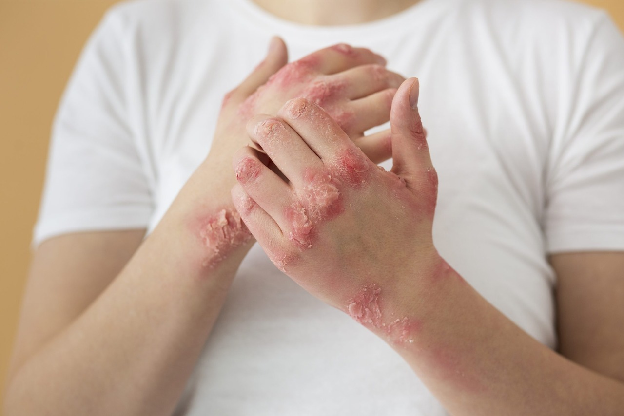 You are currently viewing Finding Peace for Your Skin: Natural Eczema Treatment Dubai